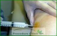 Joint Injection